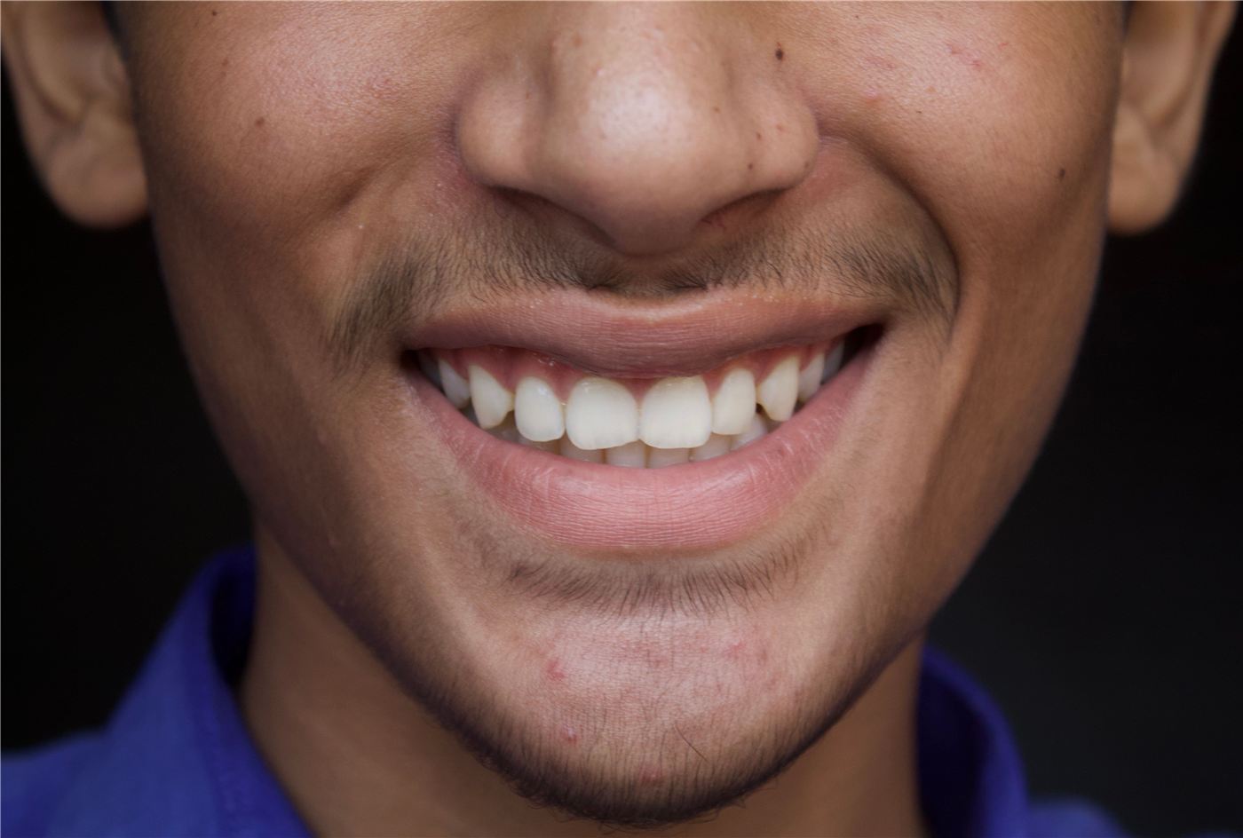 تبييض الأسنان